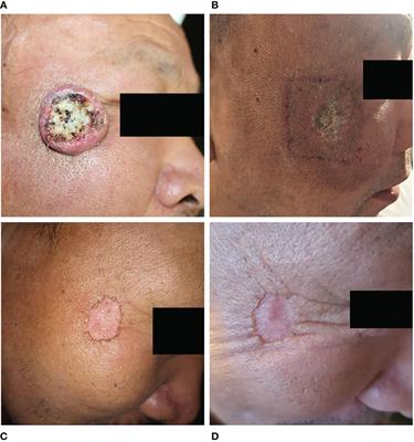 Radiotherapy for keratoacanthoma of facial skin: A case report and review of literature